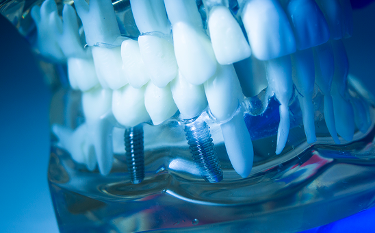 インプラントについて